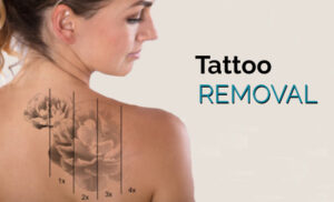 laser-tatoo-removal-az