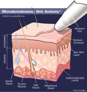 Microdermabrasion Gilbert